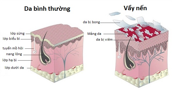 benh-vay-nen